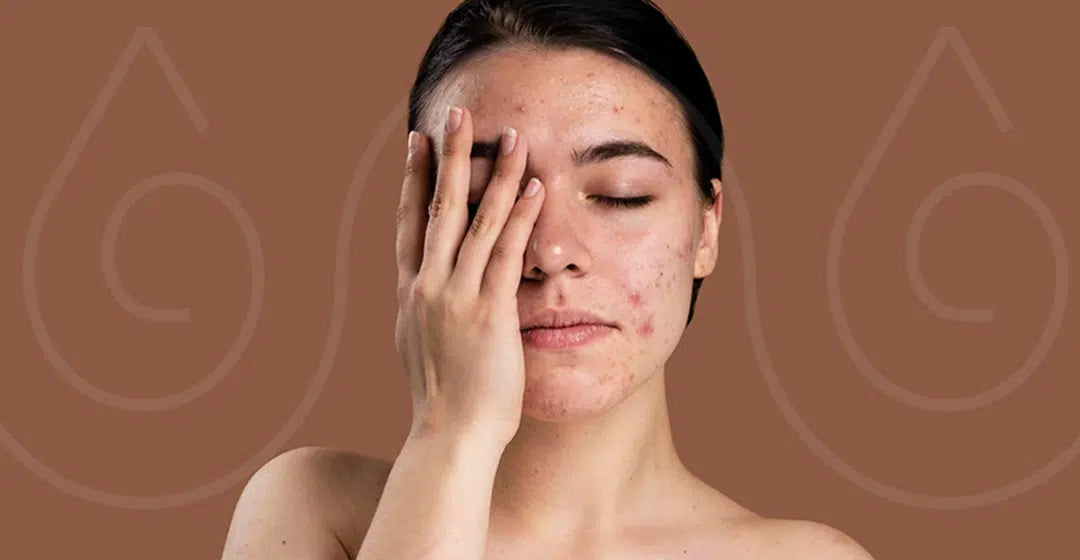 tips & face oil for acne prone skin