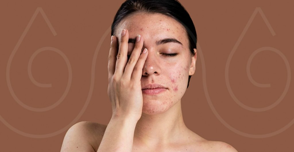 Pimples And Acne treatment